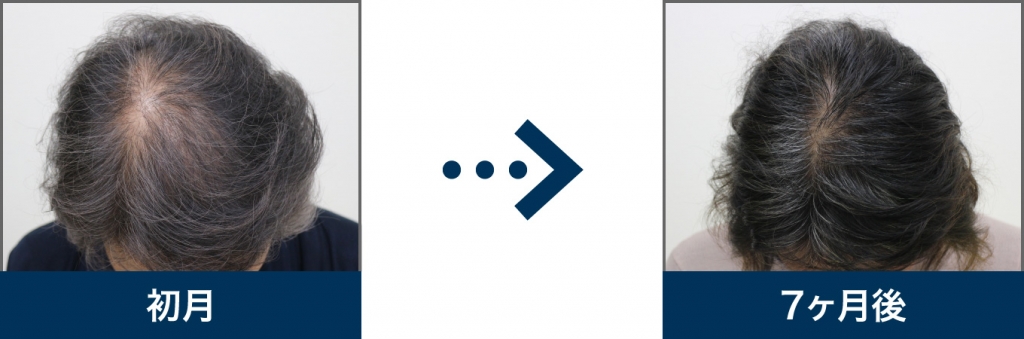 57歳 女性 治療7ヶ月