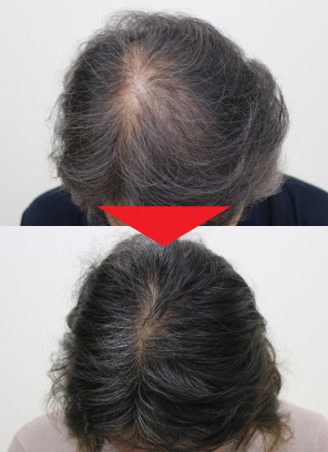 57歳女性｜発毛実績｜薄毛治療のドクターグロー